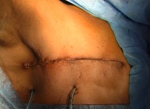 Modified Radical Mastectomy